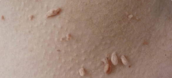 Spôsob prenosu HPV