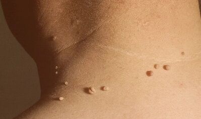 príčiny papilómov