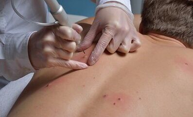 spôsoby odstránenia papilómov