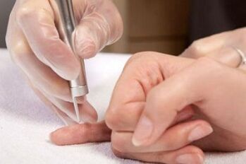 ako sa zbaviť papilómov na tele