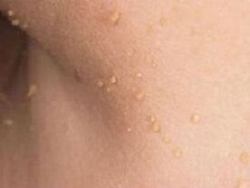 dôvody pre výskyt papilómov na tele