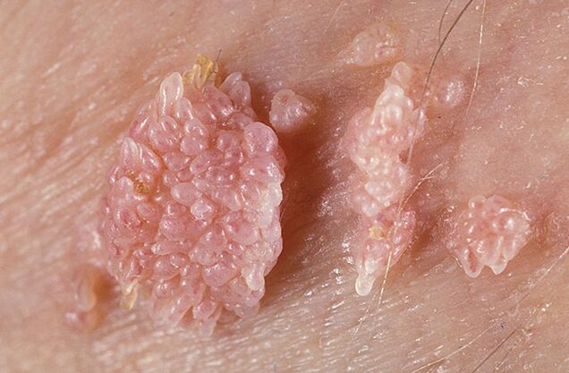 Papilóm je benígna nádorová formácia kože a slizníc bradavičnatej povahy