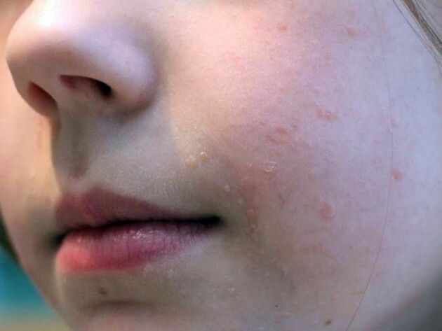 Ploché bradavice na tvári sa najčastejšie objavujú v období dospievania