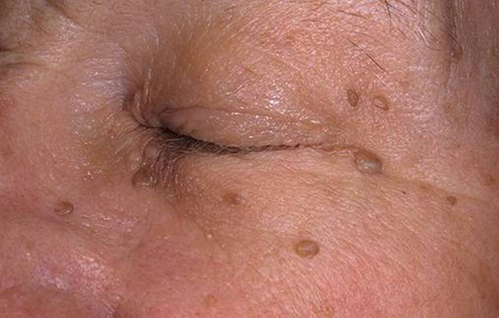Papilómy na koži tváre